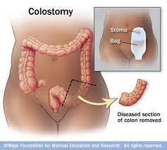Kolostomide bağırsağın hasta kısmı alınır.