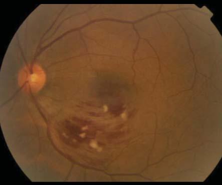 Olguların yaklaşık 1-2/3 ünü iskemik tip oluşturur. RVDT da görülen MÖ oranı % 60, retinal NV ise % 25 dir. RVDT tedavisinde lazer fotokoagülasyon, medikal ve cerrahi yöntemler uygulanabilir.