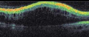 Ranibizumab ile yapılan Lucentis Branch Retinal Vein Occlusion Trials (BRAVO) faz 3 çalışmada altı aylık takip sonucunda ilacın yararlı olduğu bildirilmiştir.