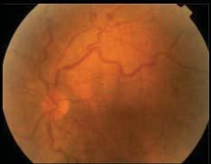 Ret-Vit 2010;18:Özel Sayı:101-107 Demircan 105 Resim 7: Makula ödemi nedeniyle intravitreal triamsinolon uygulanan ve santral retinal ven tıkanıklığı olan olgunun tedavi öncesi (a) ve sonrası (b)