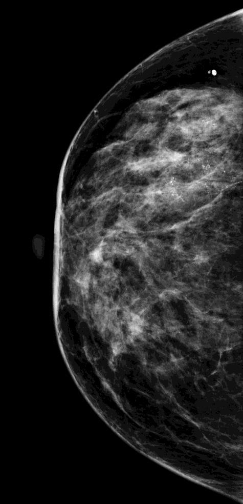 Mamografi