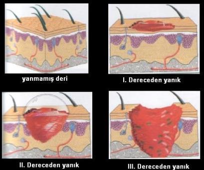 14 Yanığın