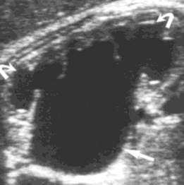 Unilateral: UPJ obstr (39-64%) UVJ obstr (9-14%)