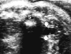 Unilateral: UPJ obstr (39-64%) UVJ obstr (9-14%)