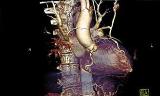 Bu sütür materyali eş zamanlı olarak sol ön inen koroner arterin stabilizasyonuna da yardımcı oldu. Hiçbir olguda prekondition uygulanmadı.