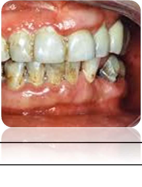 Oral hijyeninin yeterli olmadığı durumlarda ileri dönemlerde gelişebilecek periodontal doku yıkımı sonucu destekleyici kemik kaybı,