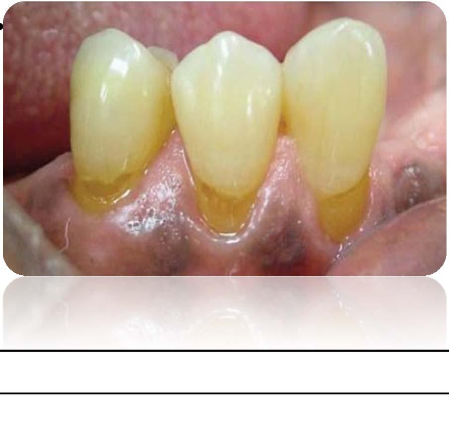 Dentin duyarlılığının etiyolojisi