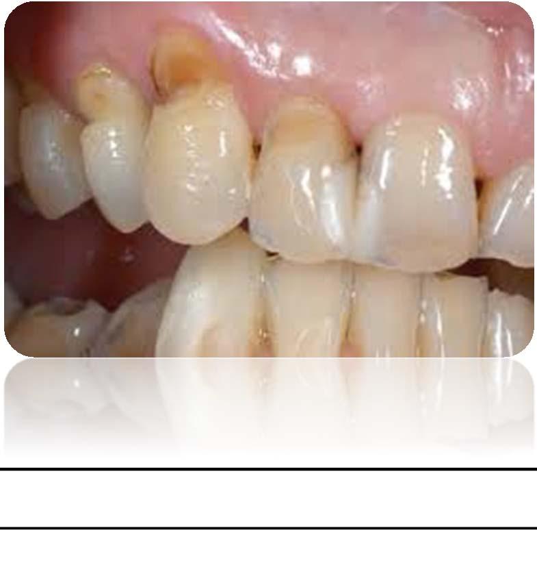 diş macunları periodontolojik nedenler ve