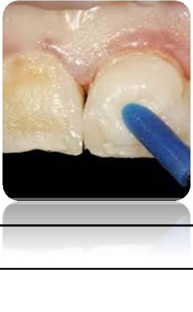 Dentin duyarlılığı tedavisinde çok eski bir yöntem ise burnishing işlemidir.