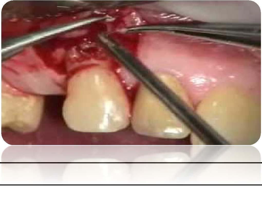 Periodontal Girişimler: Ekspoze dentin yüzeyi flepler, serbest dişeti
