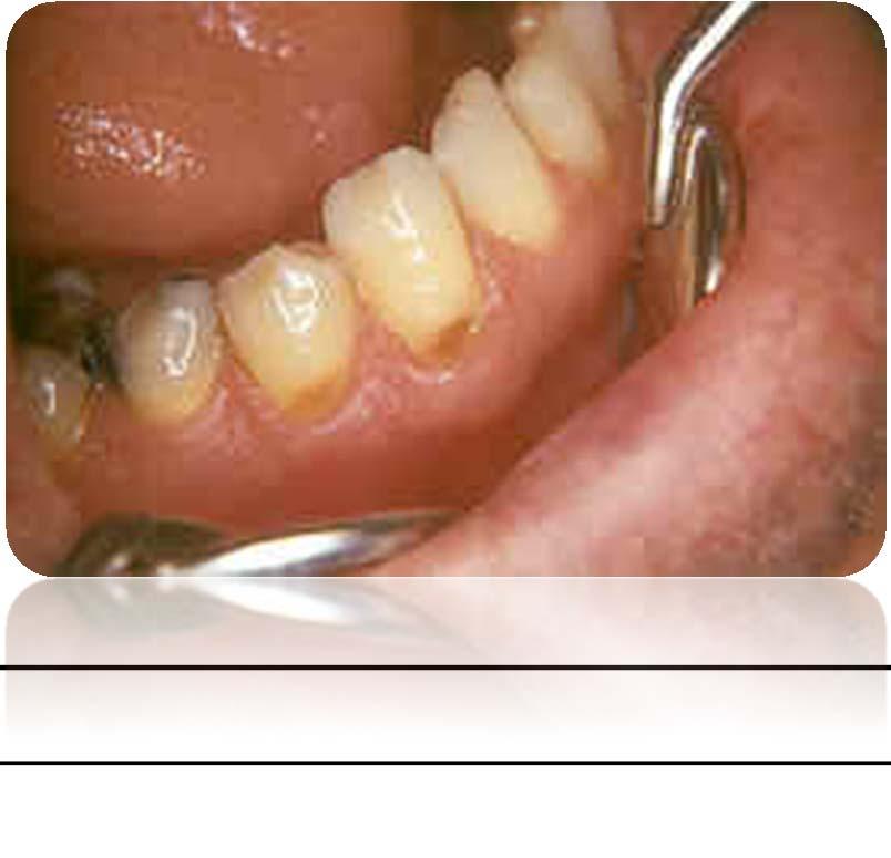 Abfraksiyon okluzal kuvvetlerden dolayı dişlerin servikal bölgelerinde mine prizmalarının gevşeyip bütünlüklerinin bozulması ve bu bölgede