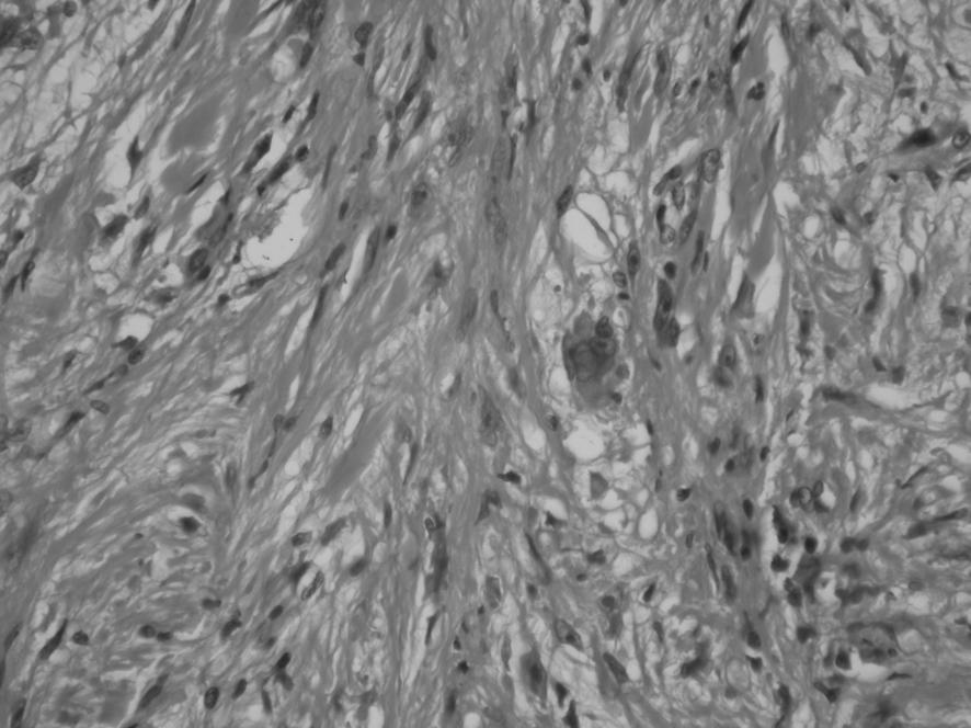 Nadir görülen histogenezi tart flmal yumuflak doku tümörleri Sternberg hücresine benzer acayip hücreler görülür. Atipik mitoz seyrek olup, 2-15/BBA civar ndad r.