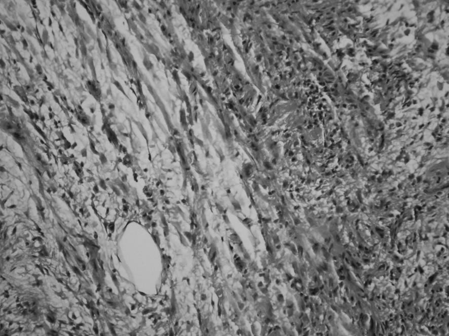 Distal ekstremitelerde yer alanlar epiteloid sarkomla kar flabilir. Harita-benzeri nekroz ve hücre morfolojisi, immünhistokimyasal panel ay r mda yard mc d r.
