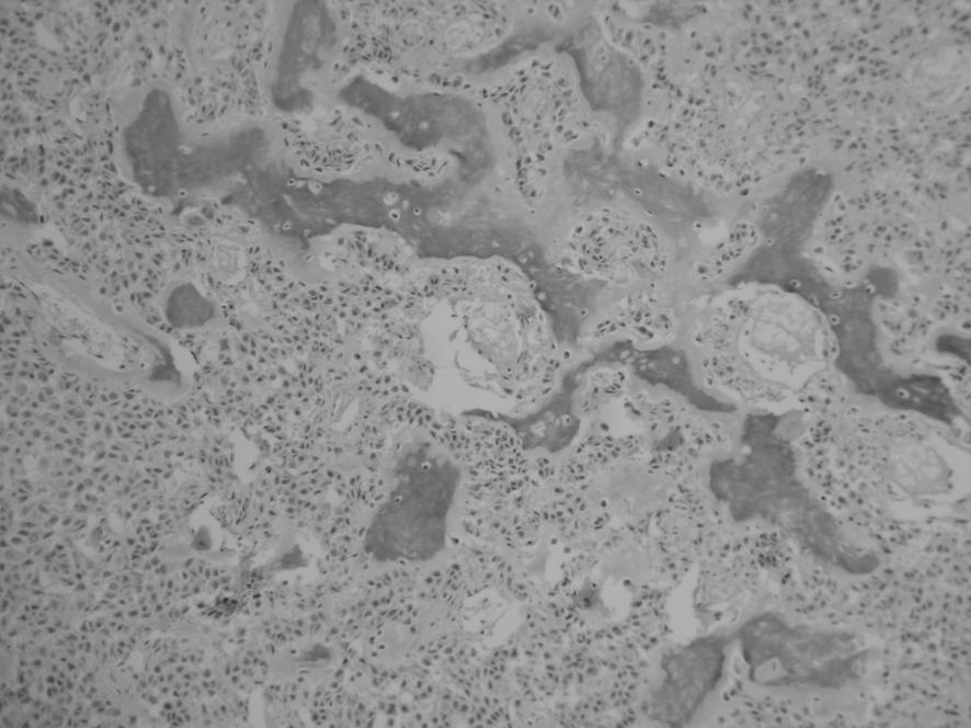 Mikroskopik incelemede tümör lobüle yap da, uniform yuvarlak ve k smen i si hücrelerin yapt kordon ve yuvalardan oluflmaktad r. Hücrelerin nüveleri soluk ve nükleoluslar belirsizdir.