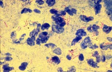 Mycobacterium tuberculosis Mycobacterium tuberculosis (1000X) Aktif tüberkülozlu bir hastanın tükürük