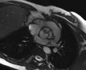 244 Arıbal ve Önder A Resim 13. A, B. Biküspid aortik kapak tanılı olguda end-diastolik görüntüde (A) aort üç küspisli olarak izlenmekte.