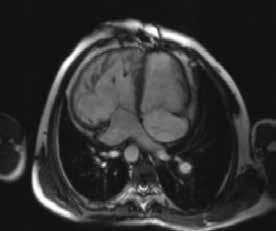 Pediyatrik Konjenital Hastalıkları 235 EĞİTİCİ NOKTA Atriyal İzomerizim Aynı anda her iki atriyumunda benzer morfolojik özelliklere sahip olması ve eşlik eden ek bulgular ve temelinde bağlantı