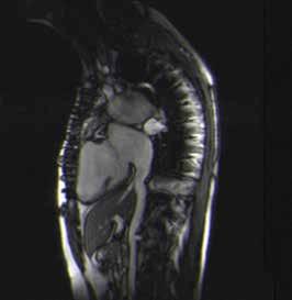 Pediyatrik Konjenital Hastalıkları 237 A Resim 5. A, B. İnferior vena kavanın drene olduğu sağ atriyum ince trabekülasyonlu, papiller kası olan morfolojik sol ventriküle açılmakta (A).