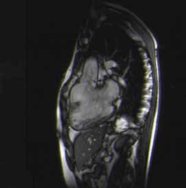 Olguda atriyoventriküler ve ventriküloarteryel ilişki bozulmuş B ventrikül hipertrofisi ve sağ ventriküle dekstropoze aorta yada bilinen diğer ismi ile ata binen aorta bulunur [20].