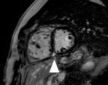 238 Arıbal ve Önder A B A Resim 6. A-D. End-diastolik dört boşluk görüntüde (A) sağ ventrikülde dilatasyon (*) görülmekte.