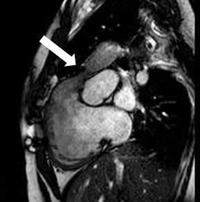Sağ ventrikülün çıkım yolu olan infindibulum genellikle kör olarak sonlanmış ve hipoplastik görünümdedir. Pulmoner arterler hipoplazik ya da atretiktir.