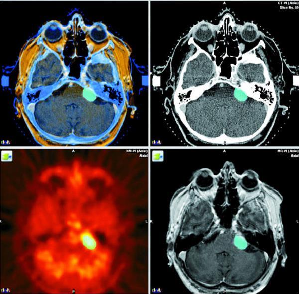 TPS de CT ile yine localizer box ile elde edilen MR, PET veya Angio görüntüleri çakıştırılarak hedef ve kritik organlar tanımlanır. (Şekil 1.11) Şekil 1.