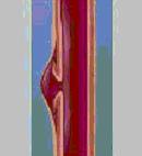 Pseudoanevrizma Genellikle iğne girişi yapılan bölgede arteriyalize ven duvarının zedelenmesi ile oluşur.