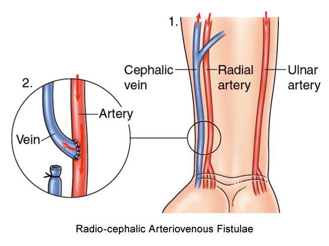 Radio-Sefalik AVF Avantajları: Oluşturulması kolaydır. Ön kolda radial arter ile sefalik ven yüzeyeldir ve birbirine yakındır.