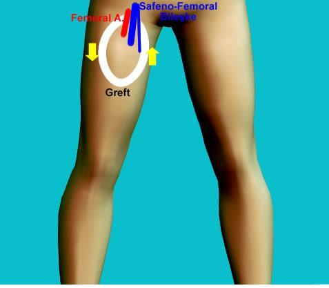 Femoral