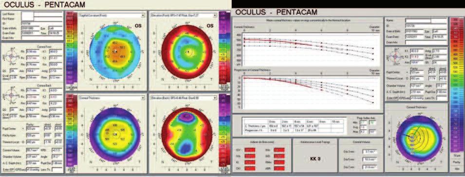 KERATOKONUSLU GÖZLERİN PENTACAM TOPOGRAFİ İLE DEĞERLENDİRİLMESİ... Faik ORUÇOĞLU RESİM 5: Miyopik ablasyon sonrası bir göze ait Pentacam topografisi.