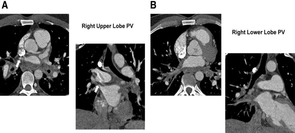 From: Pulmonary Vein Stenosis Complicating Ablation for Atrial Fibrillation: Clinical Spectrum and Interventional Considerations J Am Coll Cardiol Intv. 2009;2(4):267-276. doi:10.1016/j.jcin.2008.12.