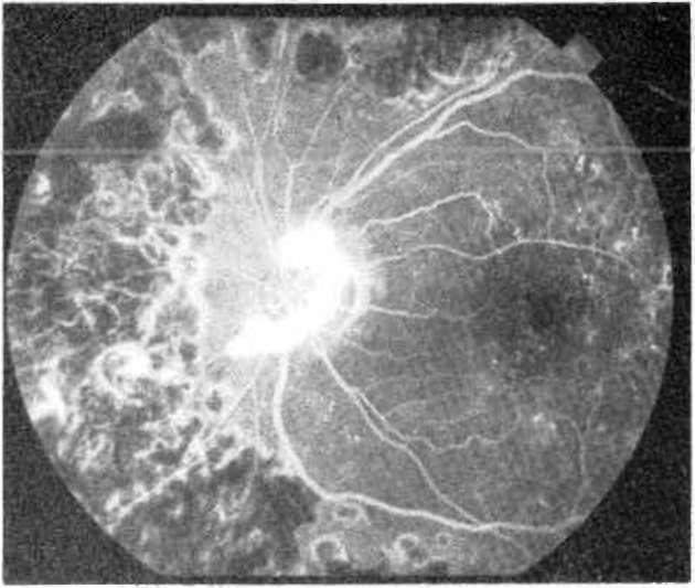 Kripton laserde hedef retina pigment epiteli olduğundan retina ödemi riski azalır (18,22,40).