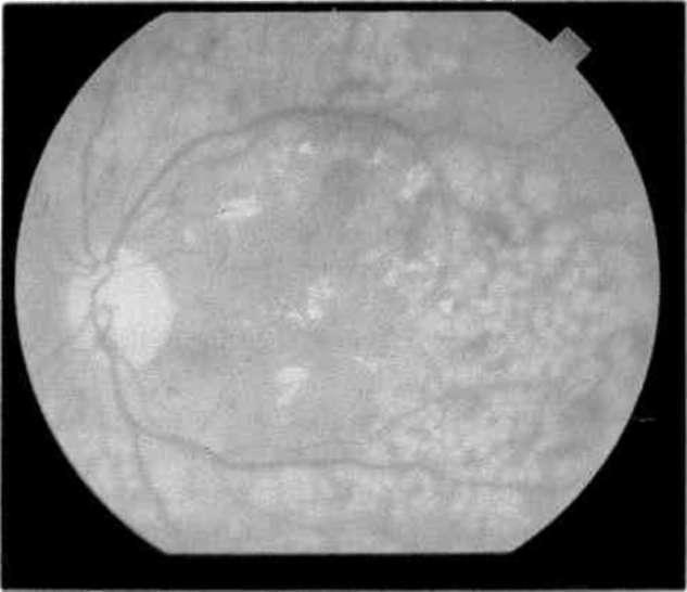 OFTALMOLOJİ MART 1993 CİLT 2 SAYI 1 Şekil 1a. Basit tipte diabetik retinopati. Şekil 1b. Aynı olgunun anjiografide oftalmoskopiye göre farklı görünümü. Şekil 2a.
