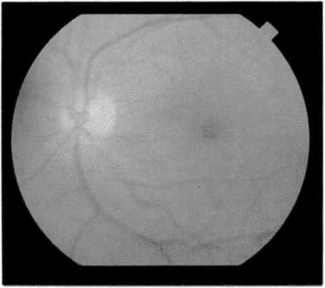 Bu nedenle tedavinin başarısı retina kalınlığının azalması yani ödemin gerilemesi ile izlenmeli, sert eksudaların kaybolmasıyla takip edilmemelidir (Şekil 5a-b) (8).