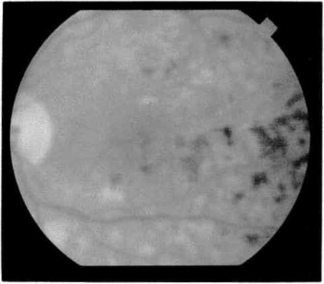 Ortasındaki mikroanjiyopatiye yapılan xenon ışık koagülasyonundan hemen sonra. Şekil 3b. Aynı olgunun 6 ay sonraki görünümü.