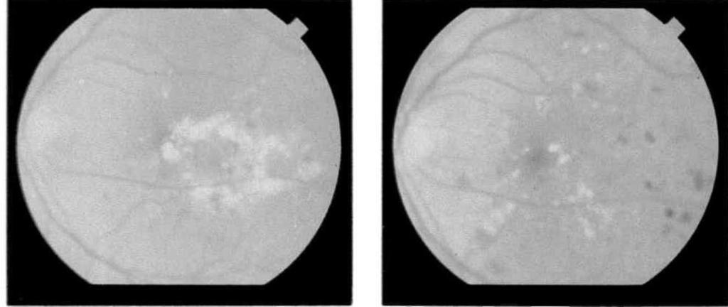 OFTALMOLOJİ MART 1993 CİLT 2 SAYI 1 Şekil 4a. Sirsine retinopati. Şekil 4b. Yeşil argon laserden 18 ay sonra. Şekli 5a. Maküiada sert eksüda plağı, san dye lasercten hemen sonra. Şekil 5b.