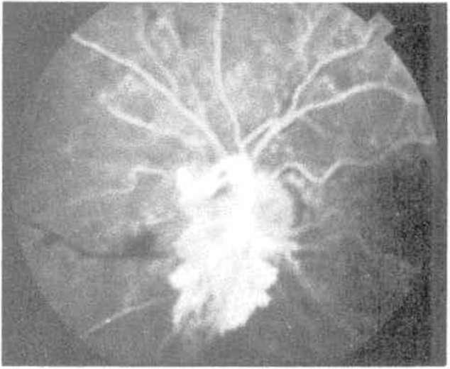 Bir diğer teknikte önce makülaya laser yapılarak 4-6 hafta sonra periferik retinaya ışık koagülasyonu tamamlanır.