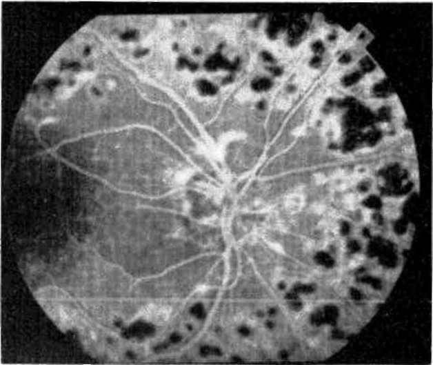 Büyük damarlara, retina önü kanamalara, koyu pigmentli korioretinal nedbe dokularına, makülanın iki disk çapı içine ve yumuşak/sert eksudalara ışık