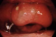 Epiglottit Subglottik