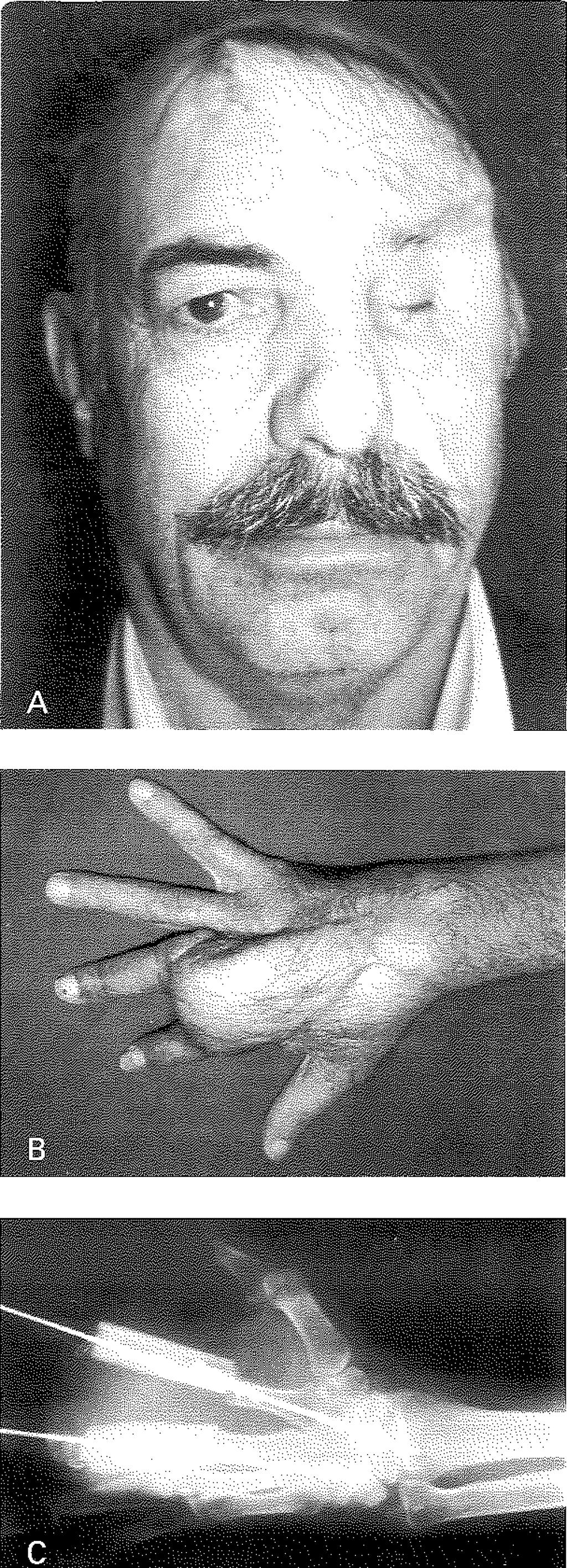 c: Aynı hastanın sağ elinin radyolojik görünümü Şekil 2A: Hastanın frontal bölgesindeki