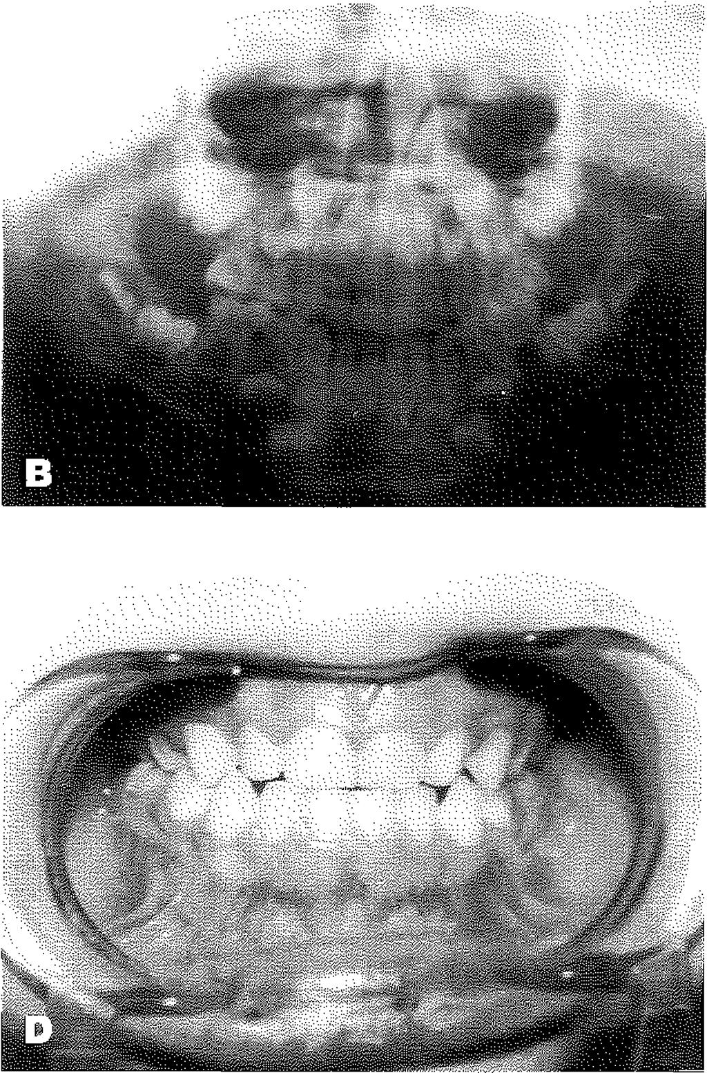 Hastamızın uzun süreli takiplerinde 4 yıl sonra diş gelişiminin normal olduğunu izledik.