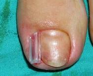 denir. Genellikle ayaklarda ve birinci parmakta görülür. Tırnak batmasının sebebi nedir?