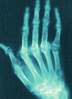 Rheumatoid Arthritis Ferrell WR