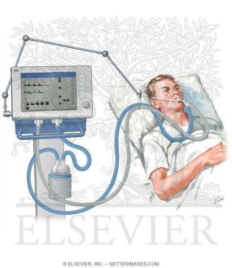 Mekanik ventilasyon yoğun bakımın en sık uygulanan ve en önemli organ destek tedavisi Yaşam kurtarıcı Ayırma (%50) %25-30 BAŞARISIZLIK