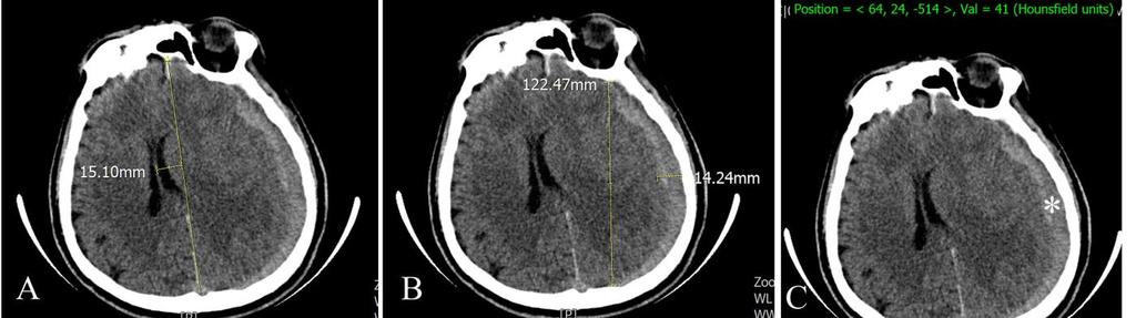 Resim 1:ASDH li olgunun BT kesitsel görüntü ve ölçümleri. Yüksekten düşme sonrası acil polikliniğe getirilen 60 yaşındaki ASDH li erkek hastanın beyin tomografisindeki yapılan ölçümler.