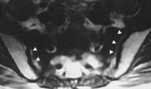 Dört olgunun MRG incelemelerinde A B T1 ağ rl kl kesitlerde, bilateral sakrum kanatlar nda asimetrik, sakral foramenlerin lateral komşuluğu boyunca sakroilyak eklemlere paralel uzanan bant şeklinde