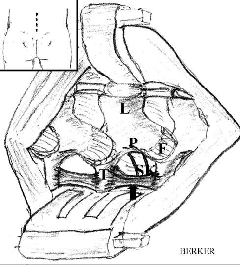 Tablo I: Hasta Verilerinin Özeti Hastaların özellikleri Erkek 5 Kadın 11 insizyonu sonrası torako-lumbar fasia açılmış, paraspinal kaslar spinöz proces ve laminalardan laterallere sıyrılmıştır.