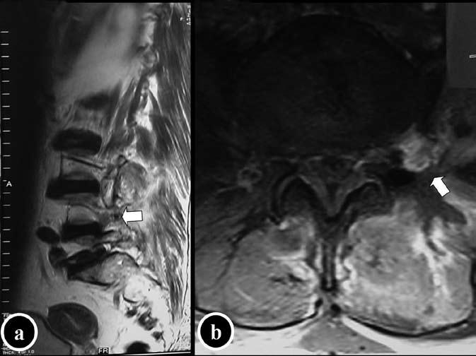 A B Şekil 4: A) L4-L5 mesafesindeki uzak lateral disk hernisinin postoperatif sagittal kesitli manyetik rezonans görüntüsü; B) L4-L5 mesafesindeki uzak lateral disk hernisinin postoperatif aksiyal