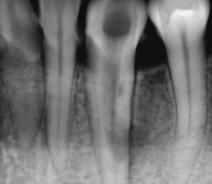 Radyografik ve klinik muayeneden elde edilen bulgulara göre, aynı dişin farklı bölgelerinde biri perforasyonla sonuçlanan iki ayrı iç kök rezorpsiyonu ve perforasyon sonucu kronik apikal abse