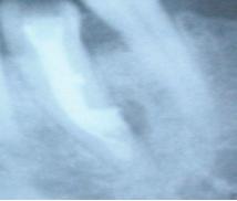 60 Kök Rezorpsiyonu Olan Bir Olgunun Endodontik ve Cerrahi Kombine Tedavisi : Olgu Sunumu yografik kontrol yapılmıştır (şekil 3). Mukoperiostal flap yerine yerleştirilerek dikiş uygulanmıştır.